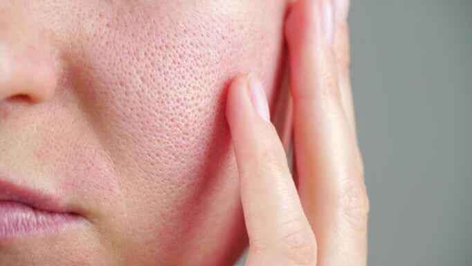 How to minimize enlarged pores